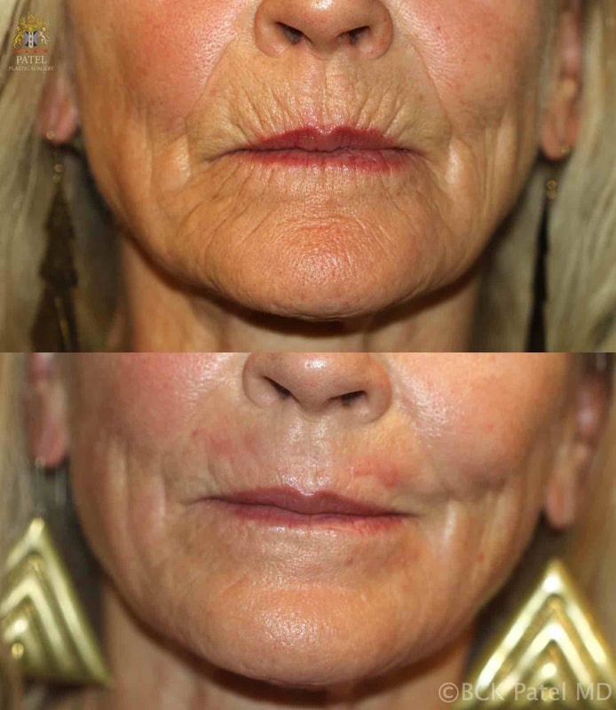 CO2 laser to lip lines by Dr. BCK Patel MD, FRCS, Patel Plastic Surgery