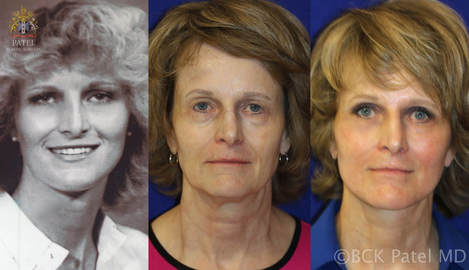 Advanced deep plane Facelift and neck lift together with use of nano fat grafts and lasers giving beautiful facelift and neck lift results by Dr. BCK Patel MD, FRCS of Salt Lake City and St. George, Utah