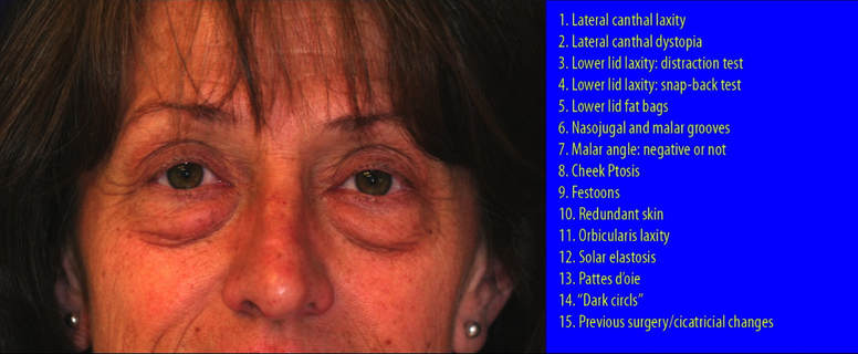 Lower blepharoplasties are, arguably, the most difficult cosmetic procedure in plastic surgery: most patients and surgeons do not realize the intricacies and the importance of a careful assessment as illustrated here in this list of analysis of the lower eyelids