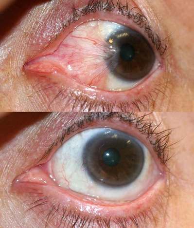Dr. BCK Patel MD, FRCS of Salt Lake City and St. George Utah removed this nasty growth on the eye causing double vision and also an unsightly eye. Removal and repair using advanced lasers, glues and techniques in Sa.t Lake City and St. George, Utah