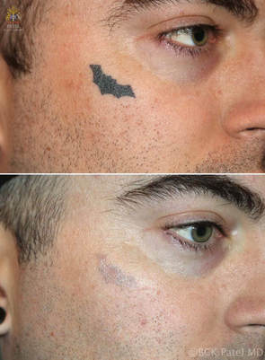 Laser tattoo removal of a dark, uniform tattoo by Dr. Bhupendra Patel MD