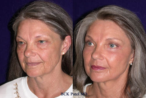 lower blepharoplasty with cheek lift