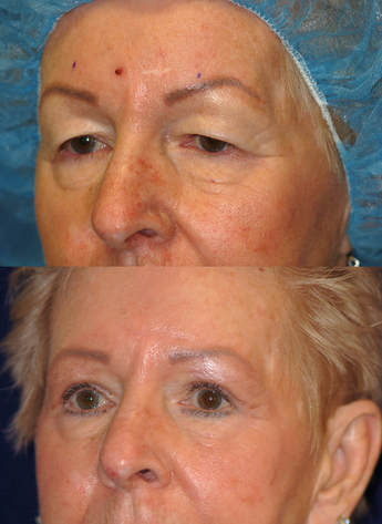 Photos illustrate the nice improvement possible by performing careful blepharoplasty with attention to detail: recreation of curves, preservation of fat, creating skin crease: results of Patel Blepharoplasty