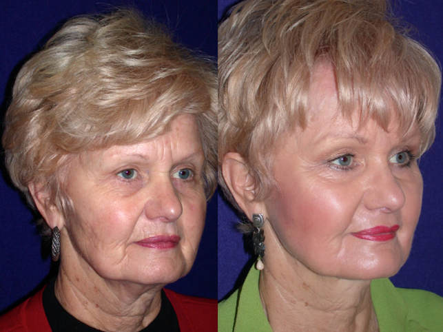 before after photographs in a female face after performing the Hammock Lift by Dr. BCK Patel MD, FRCS