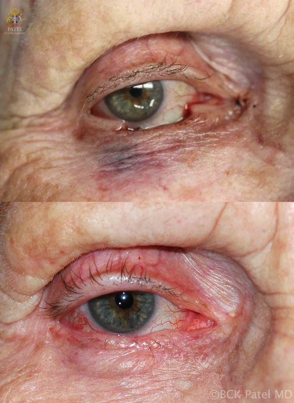 Eyelid reconstruction Basal Cell Carcinoma, by Dr. BCK Patel MD, FRCS of Salt Lake City and St. George, Utah