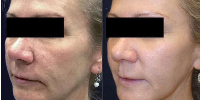 Aerolase causing skin tightening with collagen building by Dr. BCK Patel MD, FRCS