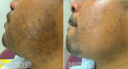 Aerolase Neo used to treat pseudofolliculitis barbae BCK Patel MD, FRCSPicture