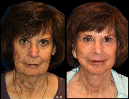 Facelift and necklift by Dr BCK Patel MD of Salt Lake City and St George, Utah