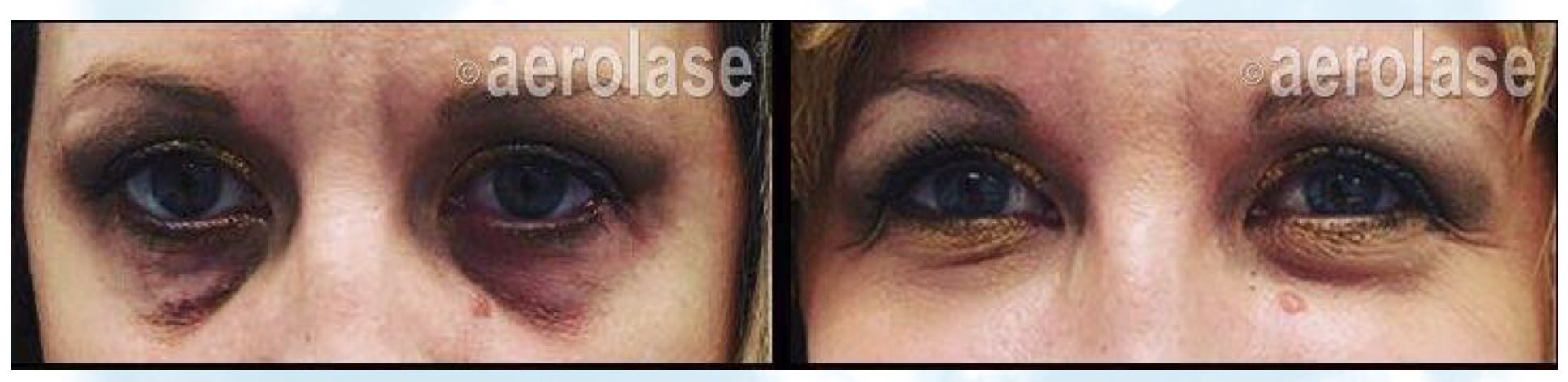 Treatment of dark circles under the eyes with filler and Aerolase Neo Laser  Dr BCK Patel MD, FRCS Plastic Surgeon, Salt Lake City and St. George UtahPicturePicture